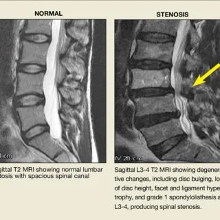 Bolečine v križu in hrbtenična stenoza